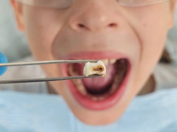Best Emergency Tooth Extraction in Soulsbyville, CA
