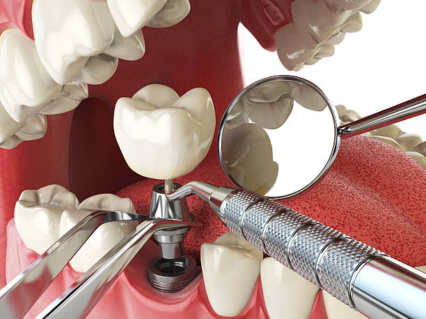 Best Emergency Denture Repair in Soulsbyville, CA