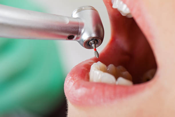 Best Emergency Root Canal Treatment in Soulsbyville, CA